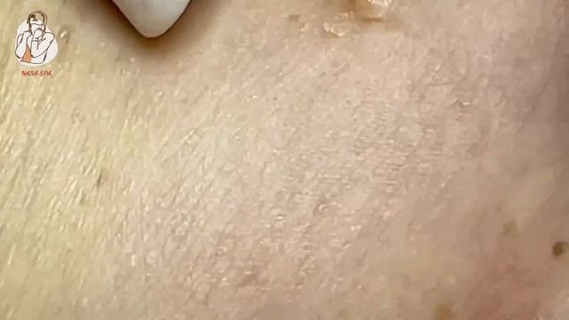 Neck Blackhead Treatment for Elderly Women смотреть онлайн