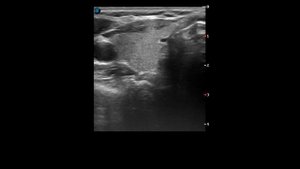 Классический папиллярный рак щитовидной железы