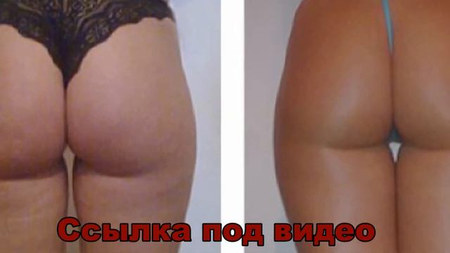 Как избавиться от целлюлита дома