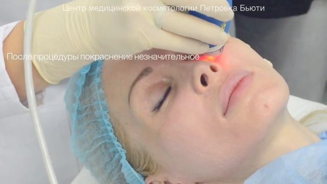 Fraxel Clear&Brilliant в центре Петровка Бьюти смотреть онлайн