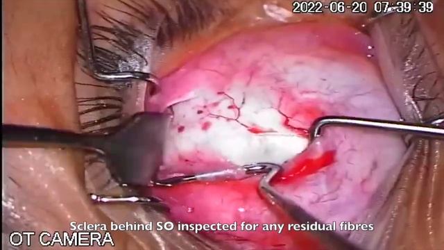 POSTERIOR TENECTOMY OF SUPERIOR OBLIQUE (PTSO)