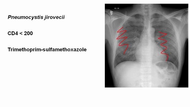 USMLE RX - 7.Микробиология - 4.Микология - 4.Pneumocystis Jirovecii  (*Пневмоцистная пневмония)