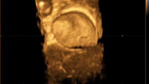 Полип желчного пузыря на 4 D