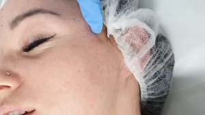 Озонотерапия лица   Основич Марина Леонидовна ЭЛАР