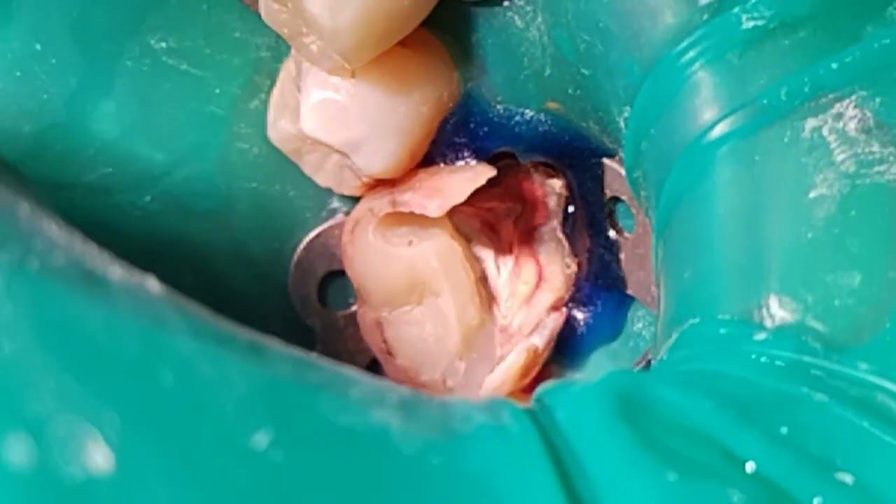 Tooth restoration.v-class.