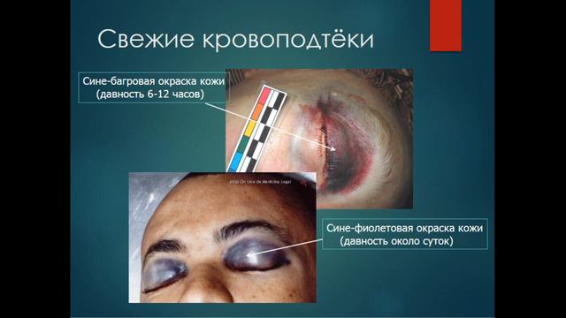 15:40  Судебно медицинская травматология