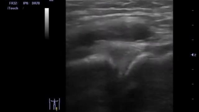 Киста мениска смотреть онлайн