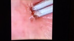 Подборка гнойных прыщей! Чёрных точек! Acne! Pimples!