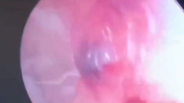 В Китае женщина жаловалась на шум в ушах оказалось, там жил паук.Женщина пришла на приём к хирургу смотреть онлайн