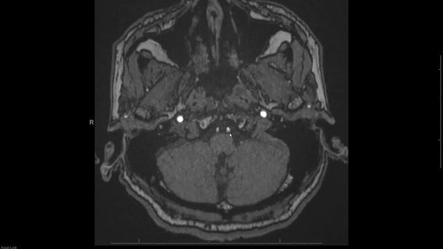 MRA (magnetic resonance angiogram) head radiology search pattern
