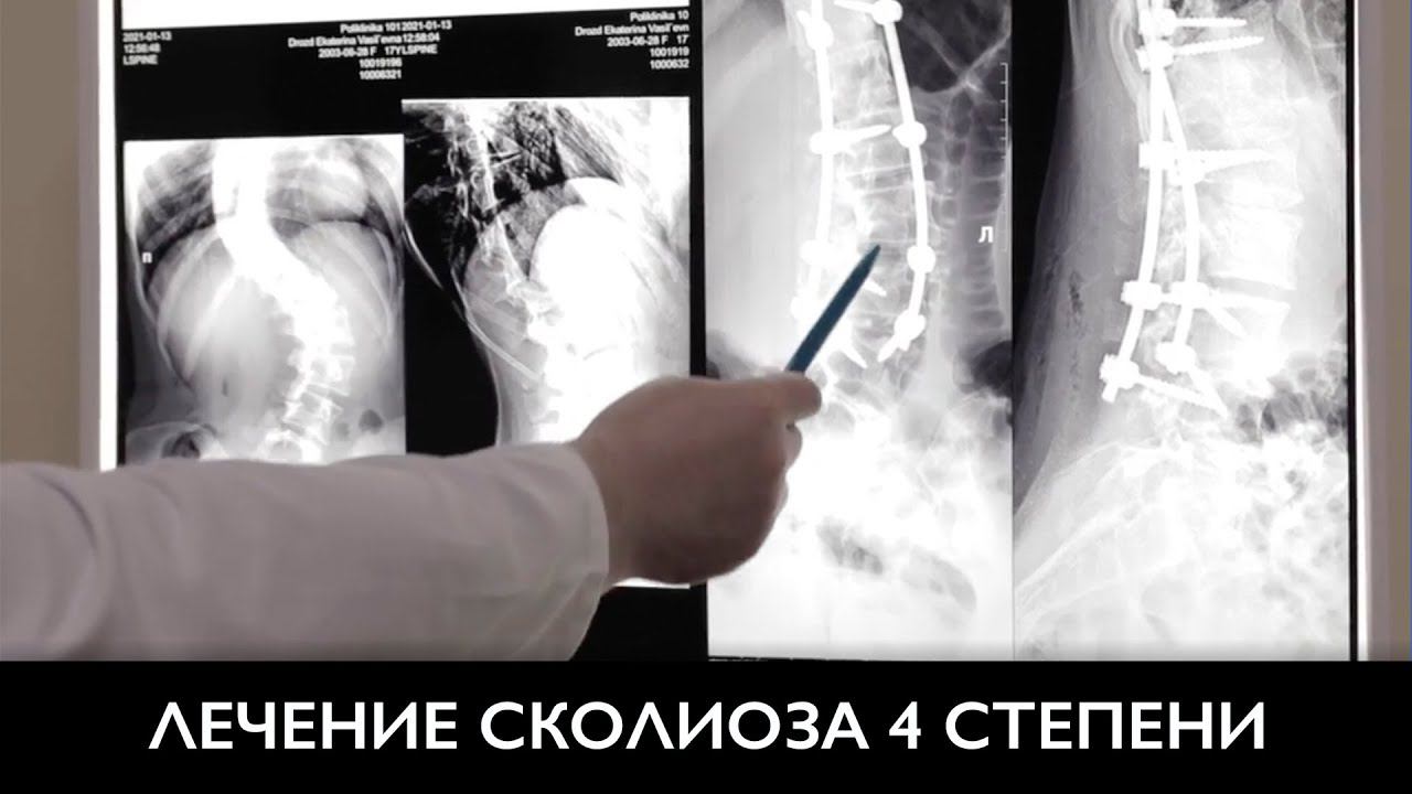 Сколиоз позвоночника | Лечение искривления позвоночника