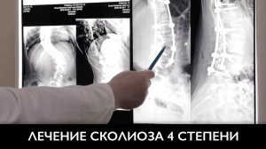 Сколиоз позвоночника | Лечение искривления позвоночника