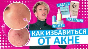 Бюджетная косметика от акне! Топ лучших продуктов!