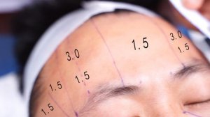 HIFU  Sincolaser Аппарат 5D Ulti-max для лифтинга лица