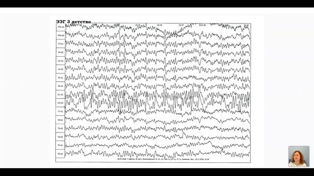 Знакомство с курсом "Особенности ЭЭГ у детей и подростков" смотреть онлайн
