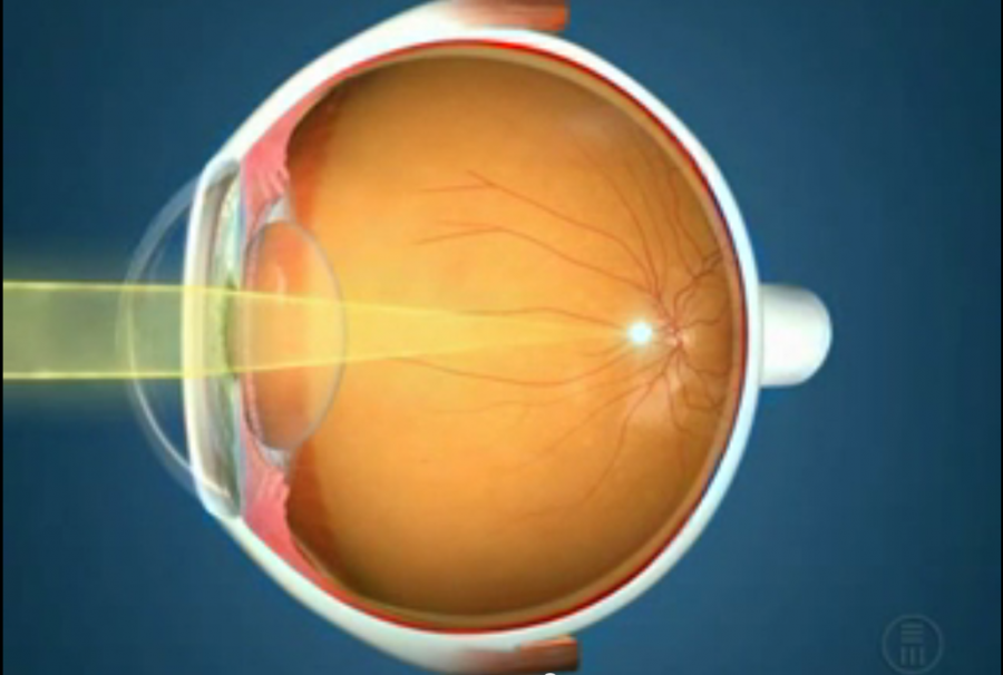 Миопия астигматизм глаз. Рефракция миопия. Рефракционная амблиопия. Отслойка сетчатки катаракта. Стекловидное тело и сетчатка.
