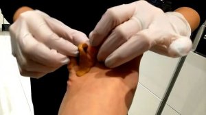 Изготовление ортеза для предотвращения межпальцевой двойной мозоли. Часть 2