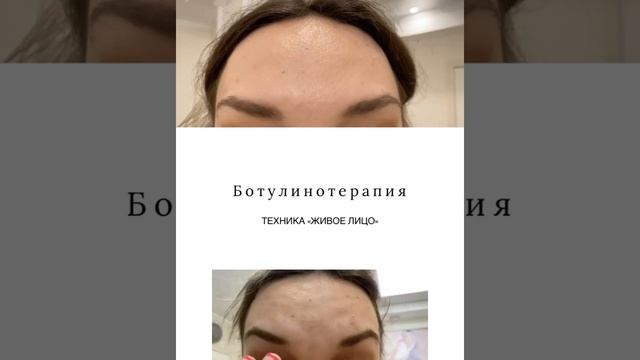 Ботокс
