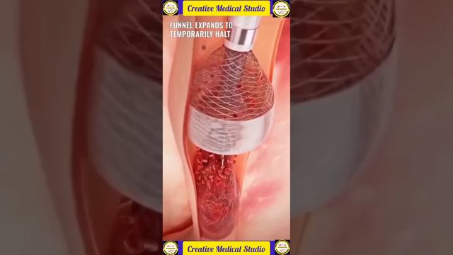 Blood clot removal animation| blood clot removal exercise.