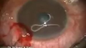 Червь в глазу