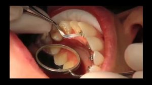 Лингвальные брекеты