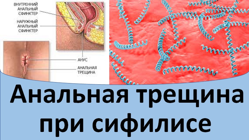 Анальная трещина при сифилисе.