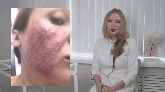 Белые папулы после инъекций смотреть онлайн