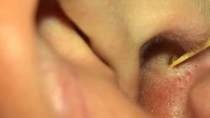 Выдавливание чёрных точек из уха / Blackhead squeezing