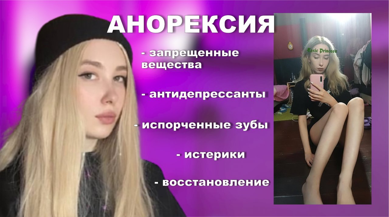АНОРЕКСИЯ РПП // моя история