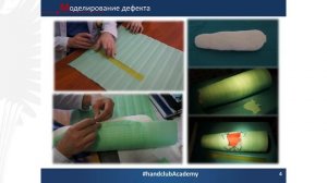 Лекция о закрытие дефектов кожи с помощью ротационных лоскутов по Лимбергу. Жигало А.В.