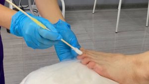 ❄️Криодеструкция удаление бородавок