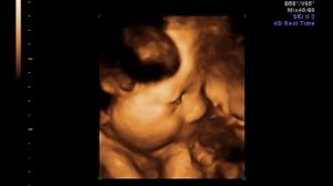 УзИ Максика 32неделя