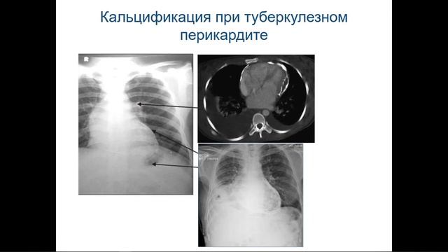 Сердечно-сосудистая патология и туберкулез: подходы к ведению пациентов