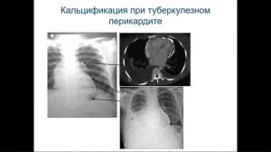 Сердечно-сосудистая патология и туберкулез: подходы к ведению пациентов