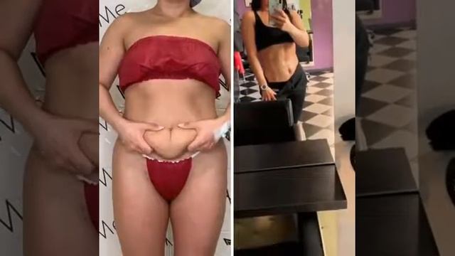 Абдоминопластика Нью Ми смотреть онлайн