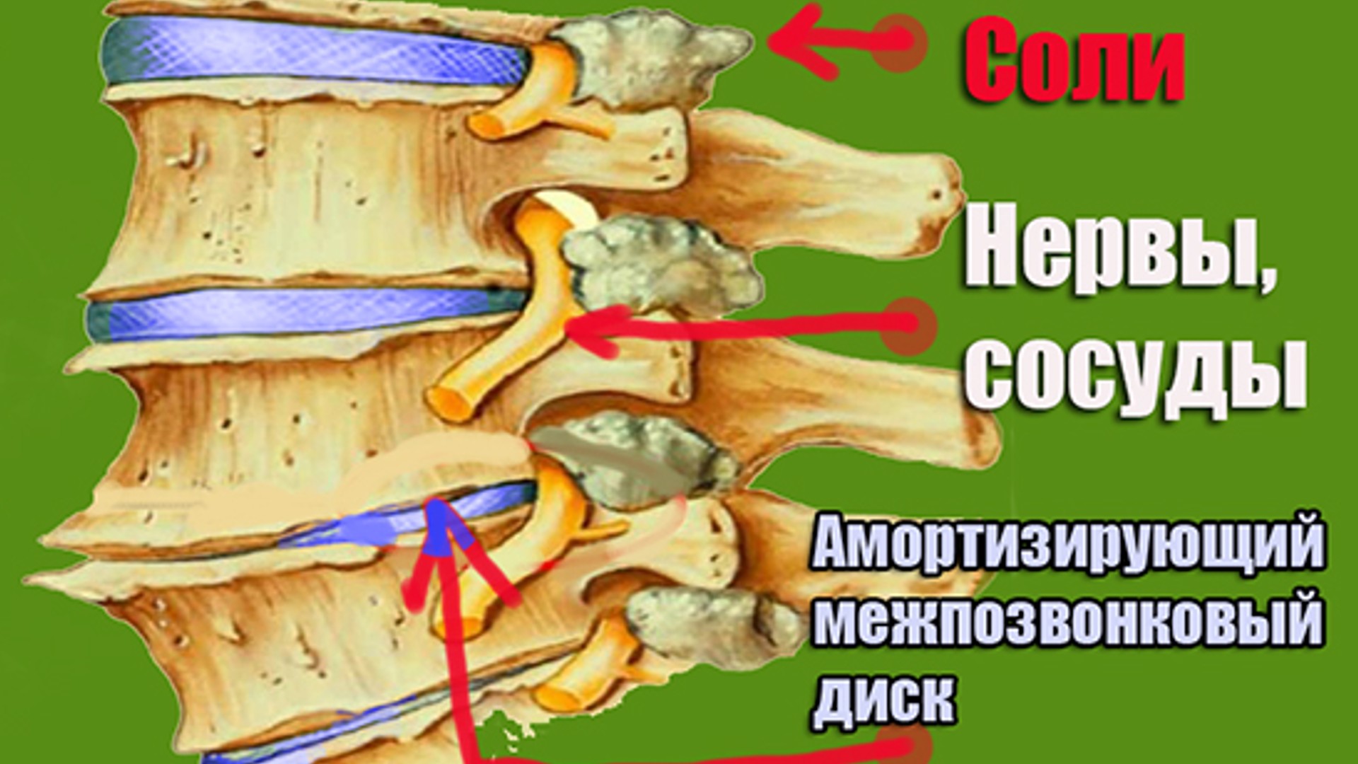 Отложение солей в позвоночнике