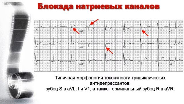 ЭКГ-токсикология: отравление блокаторами натриевых каналов смотреть онлайн