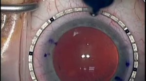 (1/2) Astigmatism Management for Modern Lens-Based Surgery