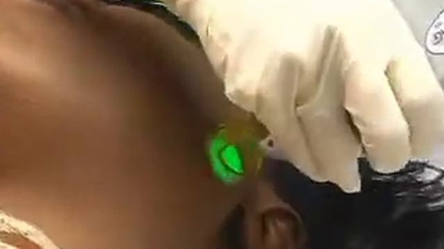 Candela Laser  Products for Cosmetic Laser Treatment Procedures 6 смотреть онлайн