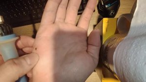 Как избавиться от бородавок