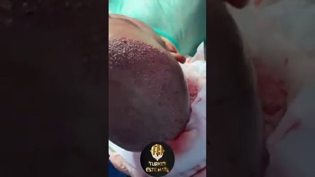 москва мужская пересадка волос