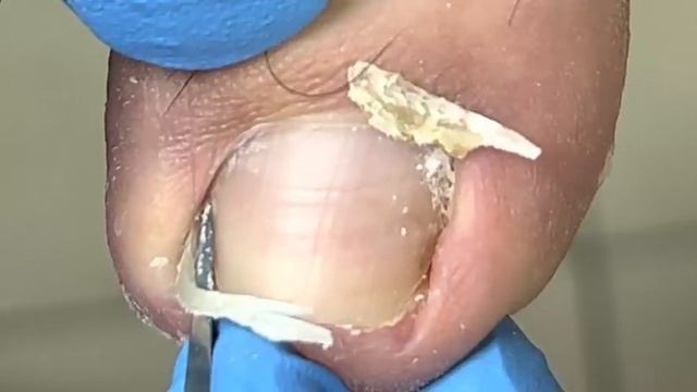 Nails that grow over time will turn yellow & nail care【Xue Yidao Pedicure】 смотреть онлайн