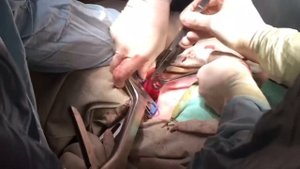 Дивертикул Ценкера