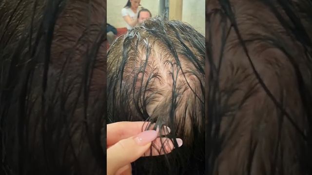 Нано капсулы на мокрых волосах. Сейчас на голове более 500 нано. Мужское наращивание волос смотреть онлайн