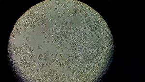 Моча больного человека под микроскопом