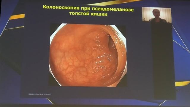 07 Иванова ЕВ Хронические запоры и колоноскопия