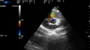 Дефект межжелудочковой перегородки