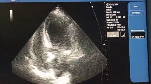 Инфаркт миокарда выявленный невропатологом