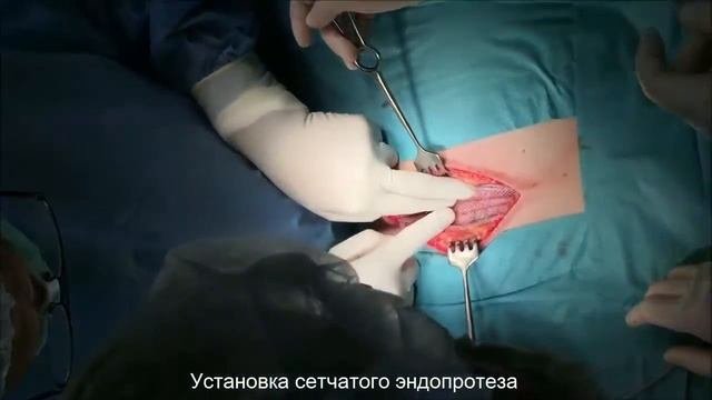 Грыжа легких. Хирургическое лечение межреберной грыжи