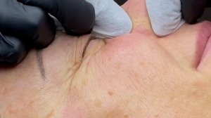 ЧИСТКА ЛИЦА / выдавливание прыщей и чёрных точек